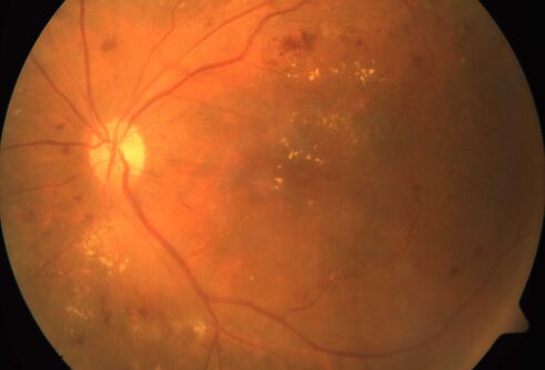 eye