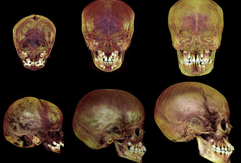 scan images of human skulls of different ages