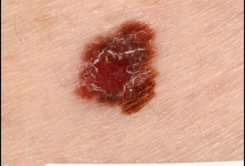 Pic of skin cancer