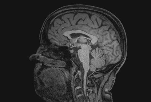 Black and white scan of a patient with Alzheimer's brain