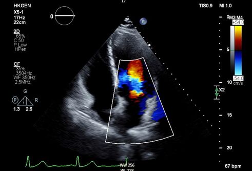 An image of a heart echo report being utilised by AI software