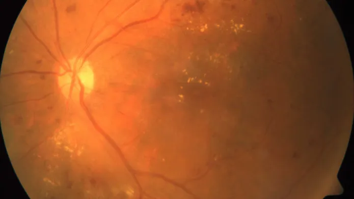 eye