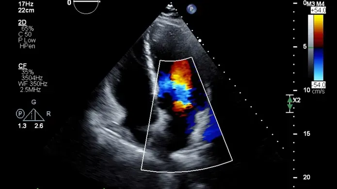 An image of a heart echo report being utilised by AI software