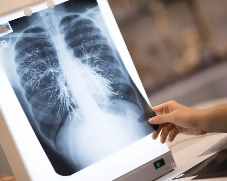 a chest xray
