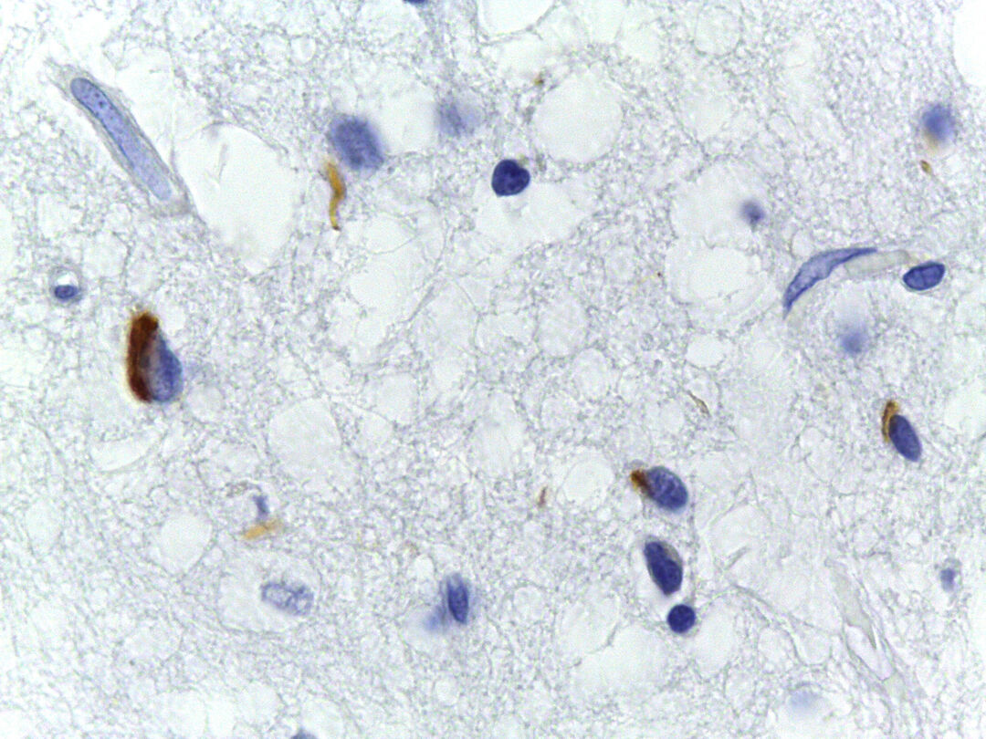 Brain tissue from a person with frontotemporal dementia examined for TDP-43 build-up (TDP-43 is the brown colour)
